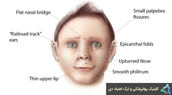 علائم سندرم جنین الکلی